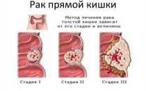 Продолжительность жизни с диагнозом рака прямой кишки