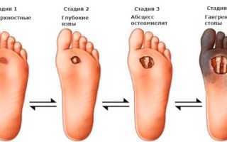 Диабет и проблемы с ногами
