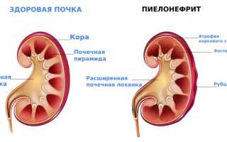 Острый пиелонефрит