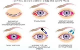 Cиндром «сухого глаза»
