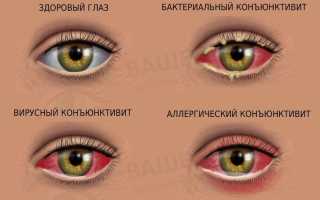Лечение конъюнктивита в разных формах