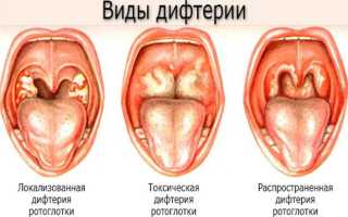 Дифтерия. Признаки и лечение