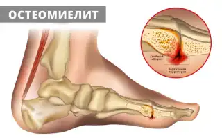 Остеомиелит