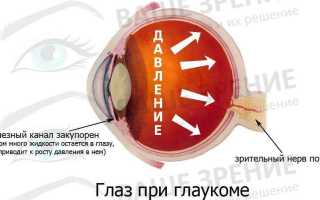 Лазерные операции при глаукоме