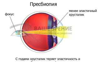 Пресбиопия: что это такое и как лечить