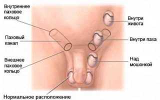 Неправильно расположение яичек. Крипторхизм
