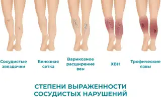 Хроническая венозная недостаточность (варикоз) и беременность