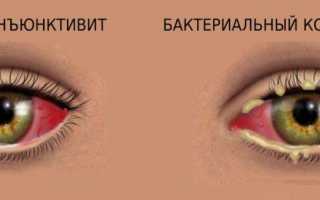 Признаки конъюнктивита глаз и как он лечится