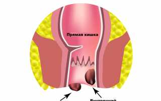 На какие заболевания может указывать боль в заднем проходе?