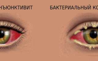 Отличия вирусного и бактериального конъюнктивита