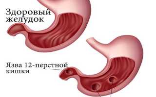 Причины и лечение вздувшегося живота с болями внизу или по бокам