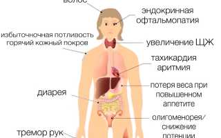 Диффузный токсический зоб
