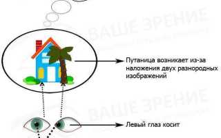 Особенности амблиопии глаза высокой степени
