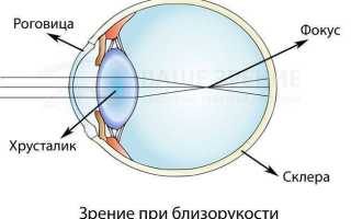 Как лечить близорукость у школьника