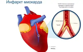 Инфаркт миокарда