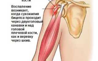 Тендинит и теносиновит