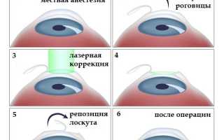Операция по коррекции дальнозоркости лазером