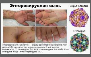 Энтеровирусные инфекции