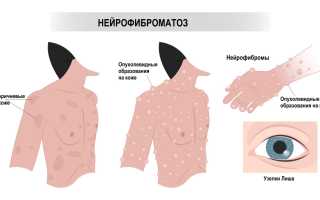 Нейрофиброматоз