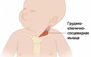 Врожденная мышечная кривошея