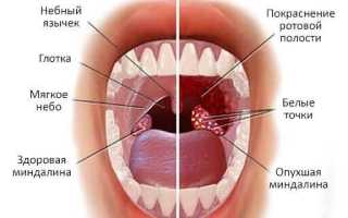 О хроническом тонзиллите