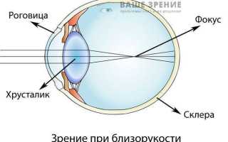 Глазные капли для глаз при миопии