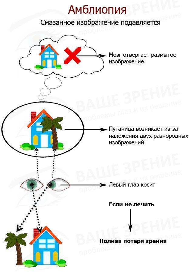 Развитие амблиопии