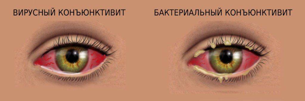 Виды конъюнктивита