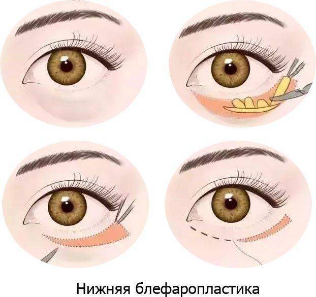 Нижняя блефаропластика