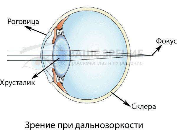 Глаз с дальнозоркостью