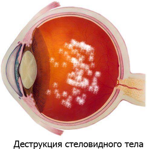 Что такое деструкция стекловидного тела