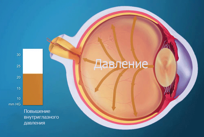 Давление в глазу: признак глаукомы