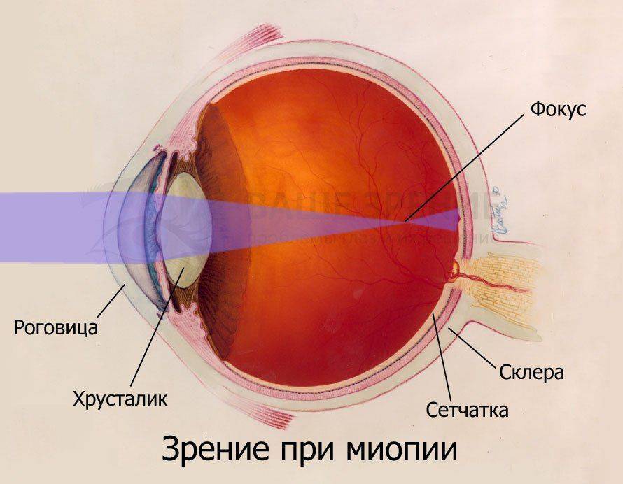 Зрение при миопии