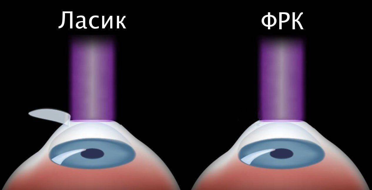 Отличия Ласик и ФРК