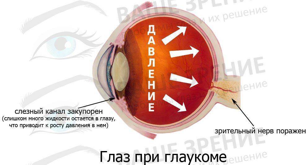 Глаз при глаукоме