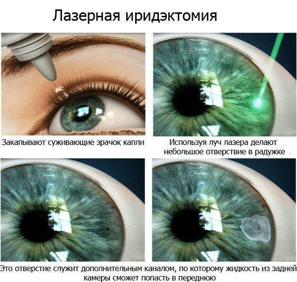 Как проводится иридэктомия