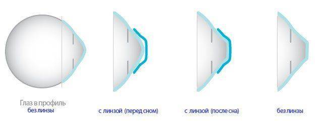 Как действует ортокератологический метод