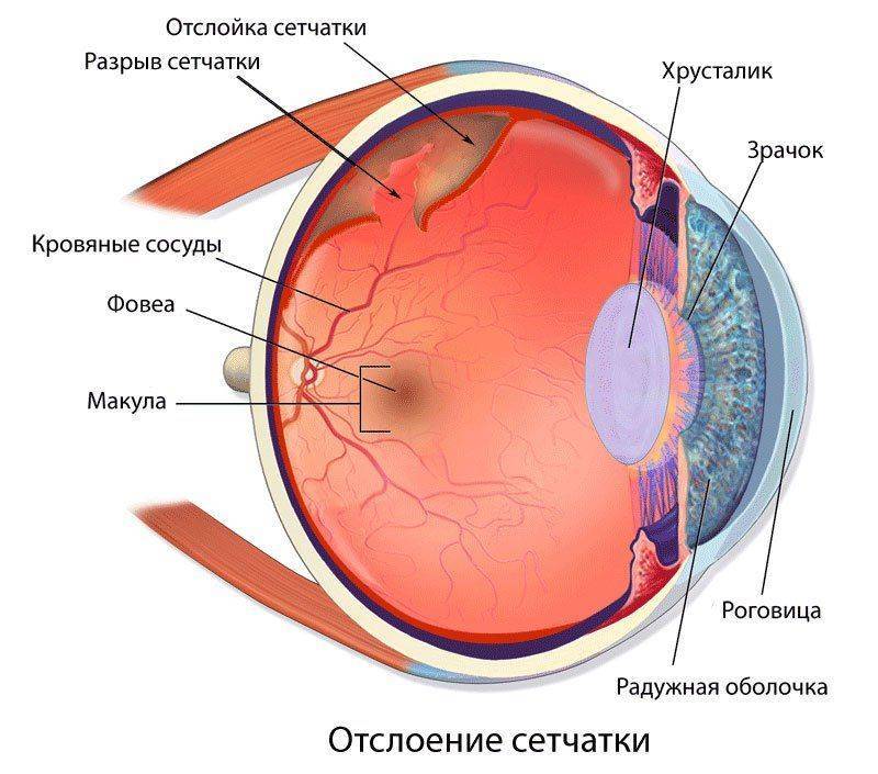 Схема отслойки сетчатки