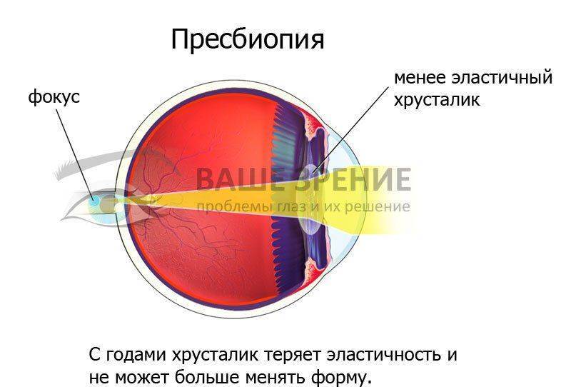 Глаз при персбиопии