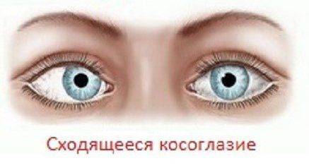 Сходящееся косоглазие
