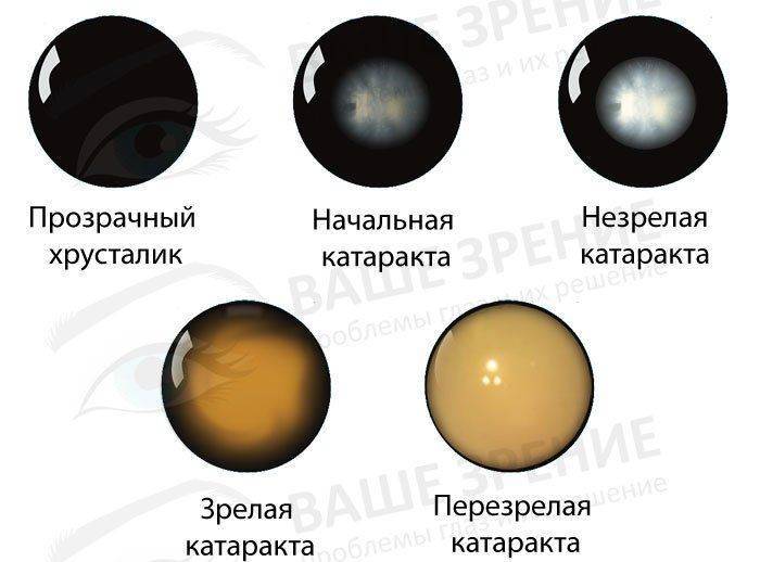 Все стадии катаракты