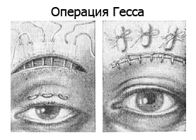 Один из видов операции при птозе