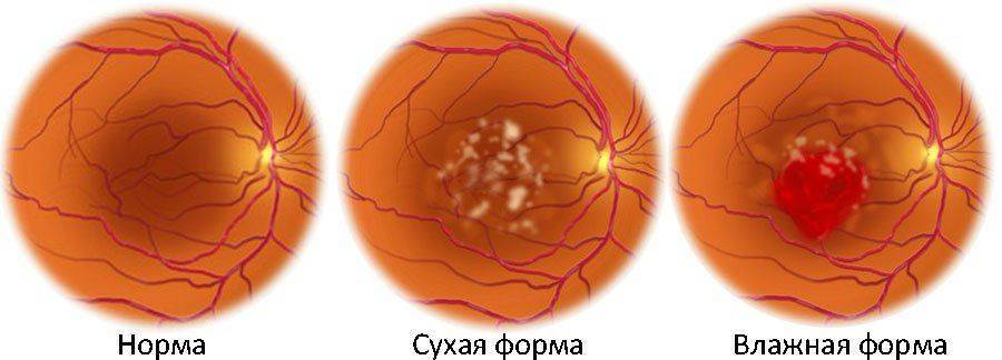 Типы макулодистрофии