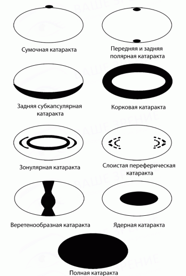 Виды катаракты