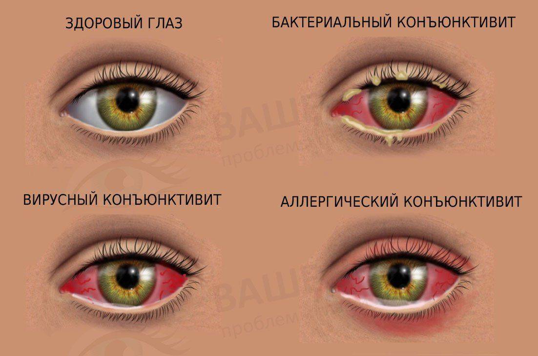 Три вида конъюнктивита и норма