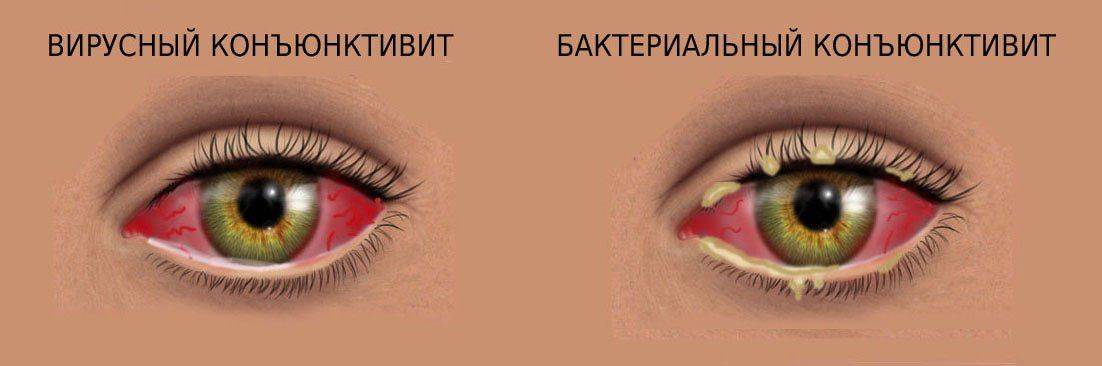 Вирусный и бактериальный конъюнктивиты: отличия