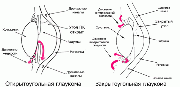 Особенности открыто-и закрытоугольной глаукомы